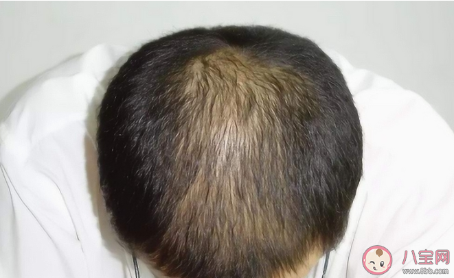 頭頂脫發(fā)的人冠心病風險高嗎 哪些征兆警惕冠心病