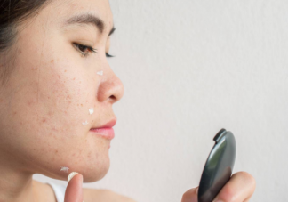 為什么月經前最容易長痘 如何改善姨媽痘