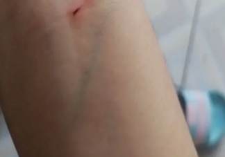 受傷了吹一吹有用嗎 傷口愈合期為什么會很癢