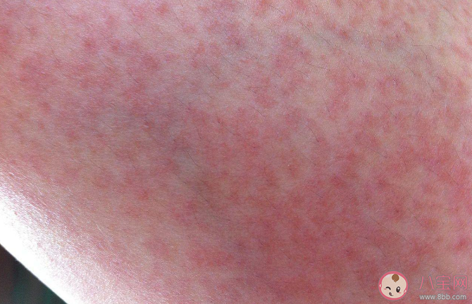 運動性過敏是怎么來的 運動性過敏有什么癥狀 運動性過敏是怎么來的 運動性過敏有什么癥狀