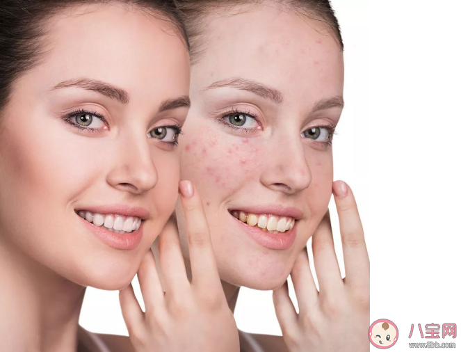 痘痘為什么會氧化變黑 這20個長痘原因你中了嗎