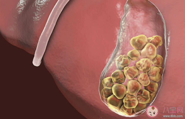 膽結(jié)石會不會變成癌 預(yù)防膽結(jié)石要多留意這4個方面 膽結(jié)石會不會變成癌 預(yù)防膽結(jié)石要多留意這4個方面