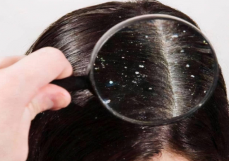 入秋之后為何頭皮屑變多 頭皮屑嚴重是什么原因