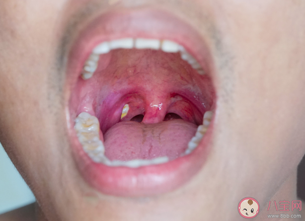 扁桃體也會長結石嗎 如何預防扁桃體結石復發