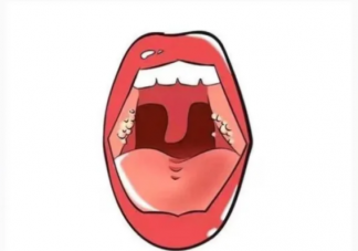 扁桃體也會長結石嗎 如何預防扁桃體結石復發