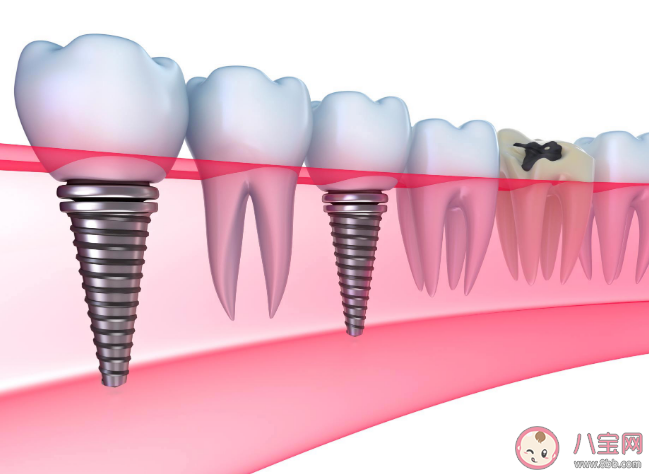 種植牙會干擾影像檢查嗎 種植牙松動了怎么辦