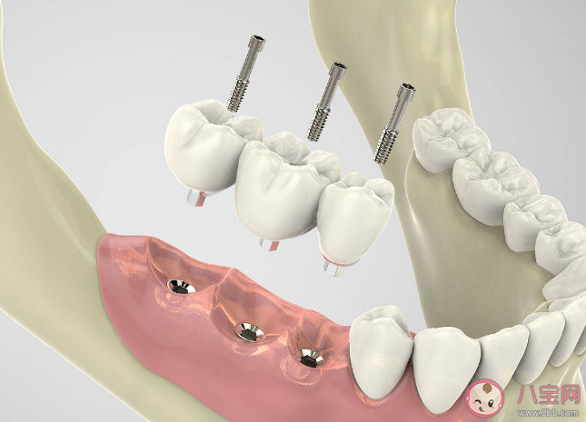 種植牙會干擾影像檢查嗎 種植牙松動了怎么辦