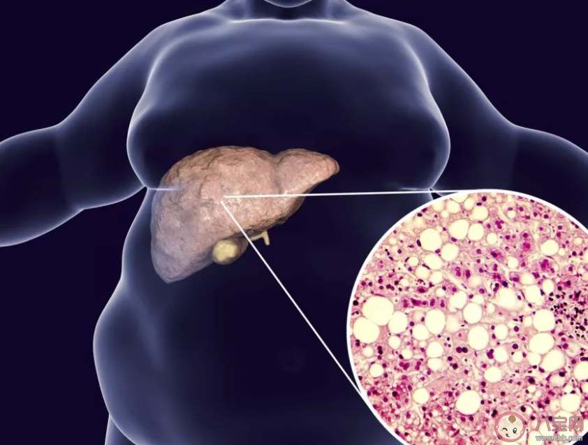 女子節食減肥減出脂肪肝是怎么回事 脂肪肝是如何產生的