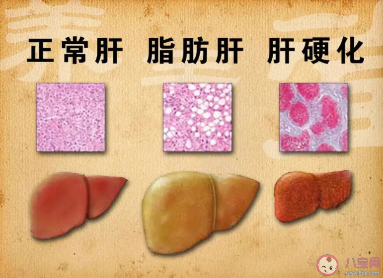 女子節食減肥減出脂肪肝是怎么回事 脂肪肝是如何產生的