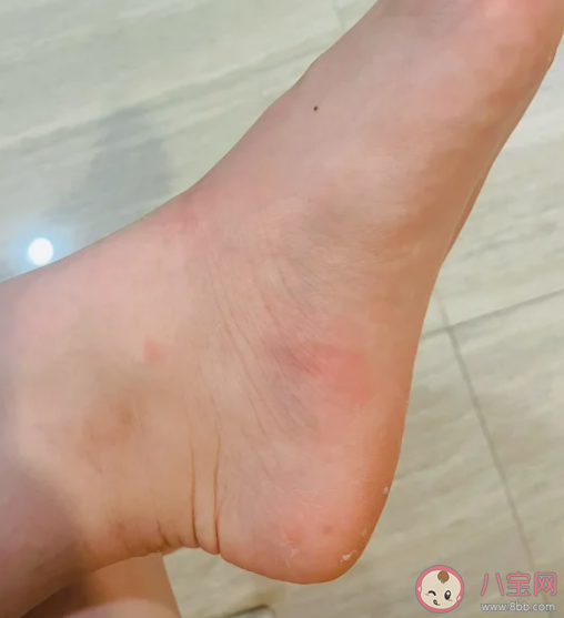 我們的癢感究竟從何而來 為什么自己撓癢感覺不到癢