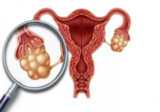 常喝咖啡會導致卵巢囊腫嗎 患有卵巢囊腫會有感覺嗎