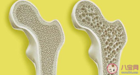 女子每天3杯咖啡被確診骨質疏松 咖啡喝多了會導致骨質疏松嗎