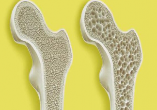 女子每天3杯咖啡被確診骨質(zhì)疏松 咖啡喝多了會(huì)導(dǎo)致骨質(zhì)疏松嗎