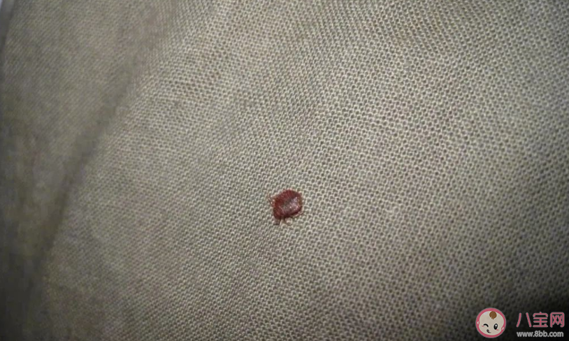 旅行中如何防止床虱跟回家 被床虱叮咬如何處理 旅行中如何防止床虱跟回家 被床虱叮咬如何處理