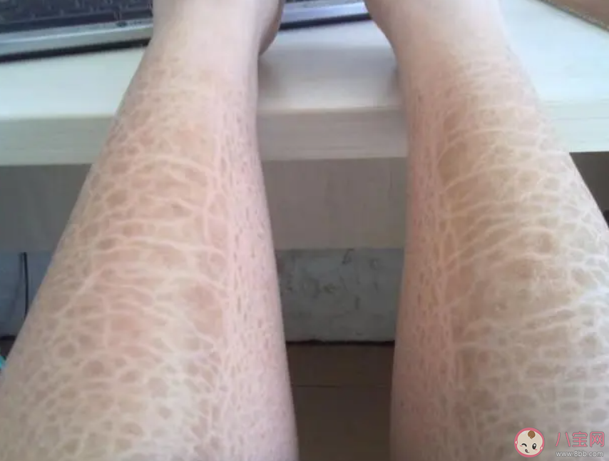 蛇皮腿是怎么一回事 怎樣護(hù)理蛇皮腿 蛇皮腿是怎么一回事 怎樣護(hù)理蛇皮腿