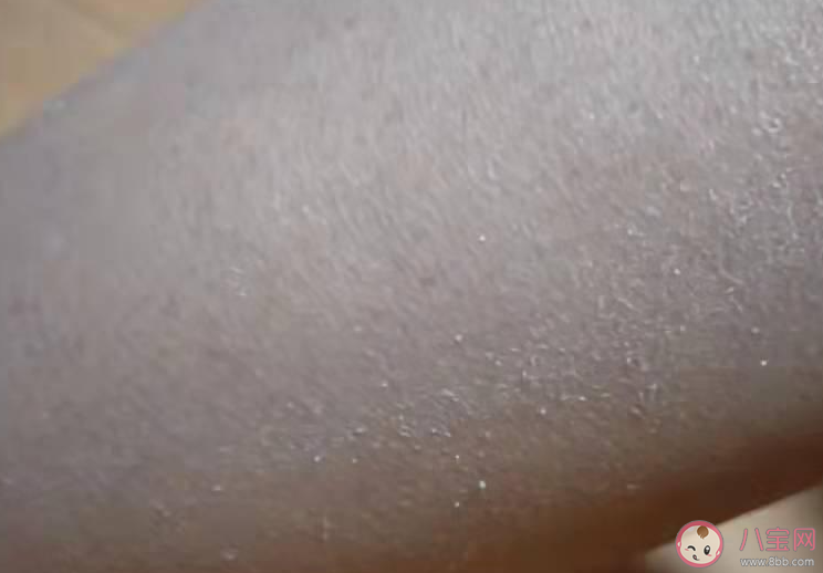 蛇皮腿是怎么一回事 怎樣護(hù)理蛇皮腿 蛇皮腿是怎么一回事 怎樣護(hù)理蛇皮腿