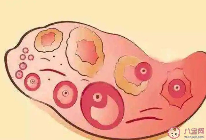 排卵后1周是黃體破裂高危期嗎 如何避免黃體破裂