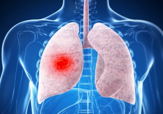 29歲姑娘無癥狀確診肺癌是怎么回事 導致肺癌的原因有哪些