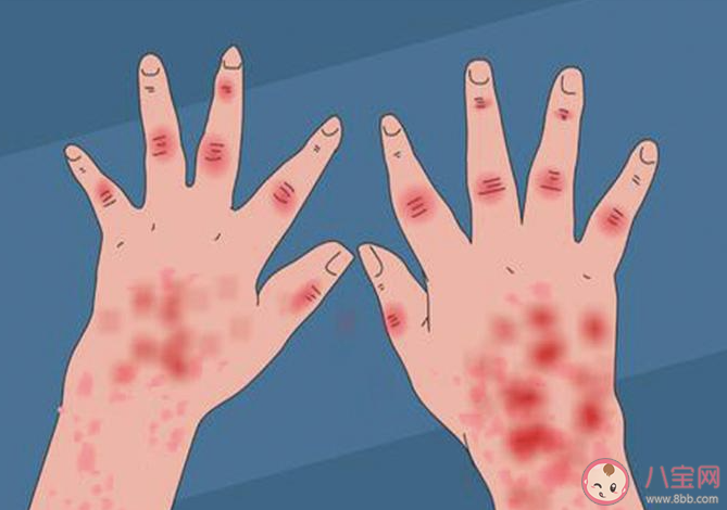 紅斑狼瘡高發人群是年輕女性 為什么會得紅斑狼瘡