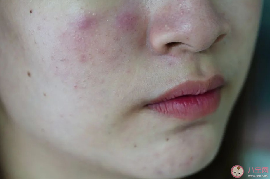 為什么臉這么油手卻這么干 臉部出油多如何清潔保濕 為什么臉這么油手卻這么干 臉部出油多如何清潔保濕