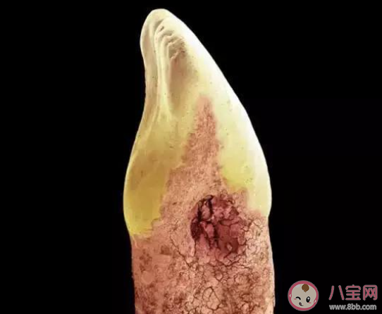 牙菌斑過多的表現有哪些 牙齒長牙菌斑了怎么辦