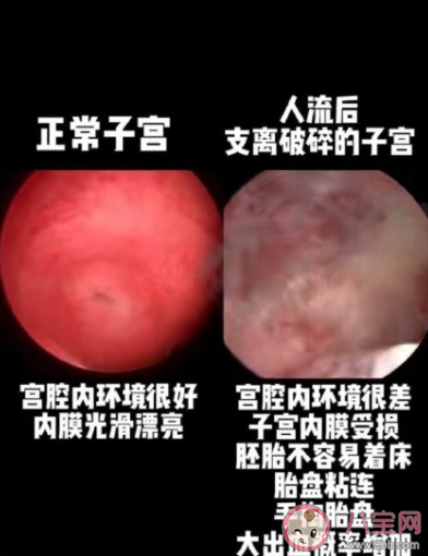 人流后支離破碎的子宮 人流會帶來哪些傷害