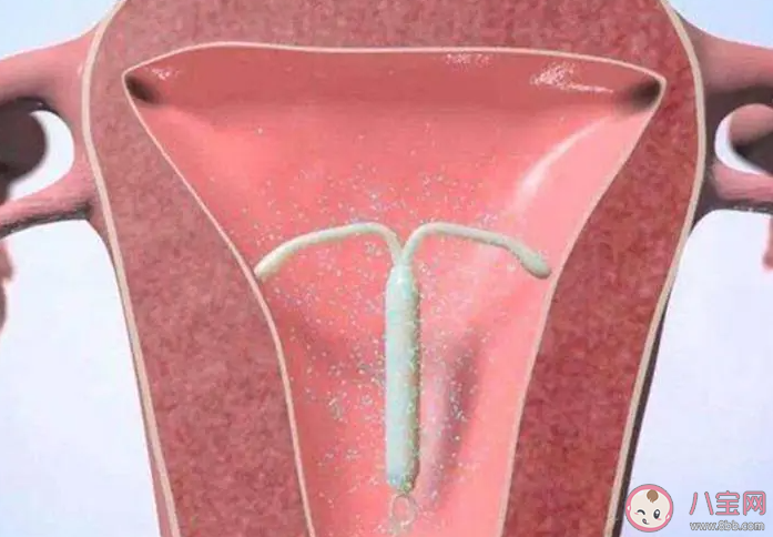 節(jié)育環(huán)真的是讓子宮不斷發(fā)炎來(lái)避孕嗎 節(jié)育環(huán)過(guò)了保質(zhì)期一定要取出嗎