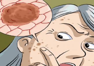 00后長期熬夜長出老年斑是怎么回事 年輕人為什么會長老年斑